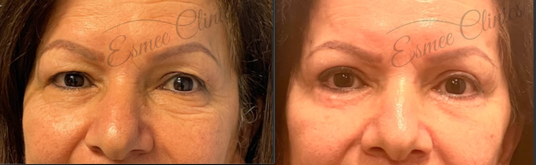 Before and After img